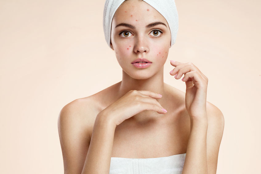 5 Effective Ways To Get Rid Of Acne Quickly