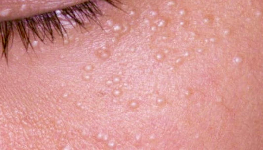 Milia Seeds: What They Are, And How To Get Rid Of Them