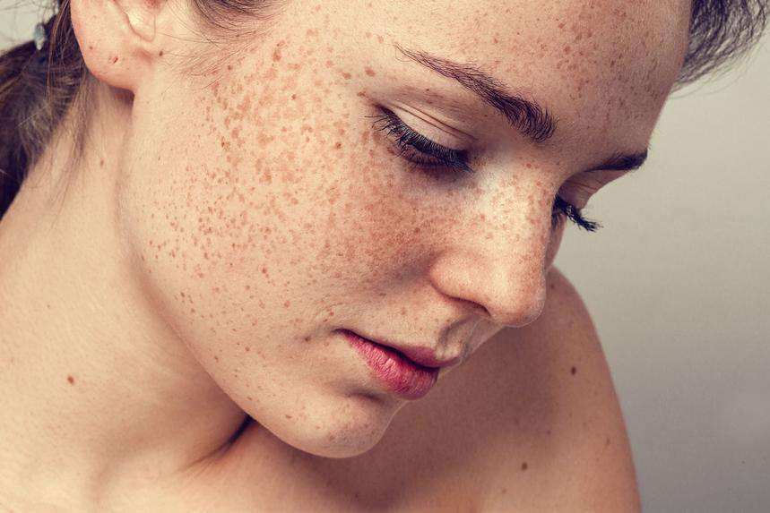 5 Ways To Fight Sun Spots And Hyperpigmentation