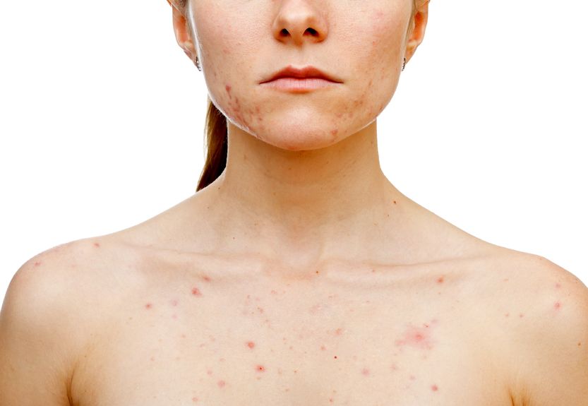 Acne: What It Is, And What Causes It