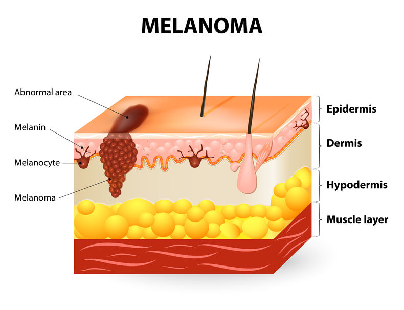 How to spot a melanoma — Dermatology Arts