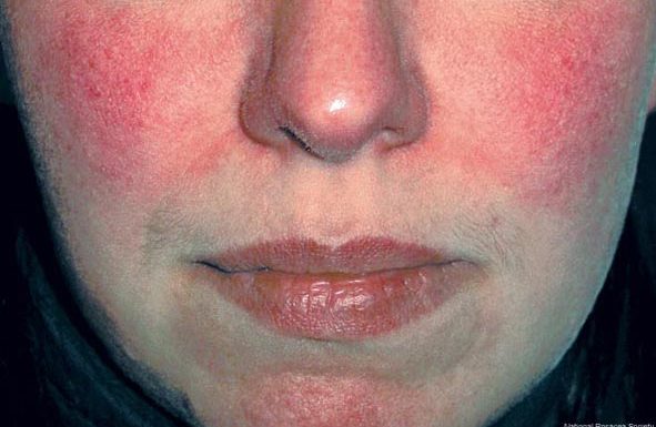 Rosacea: How To Cope