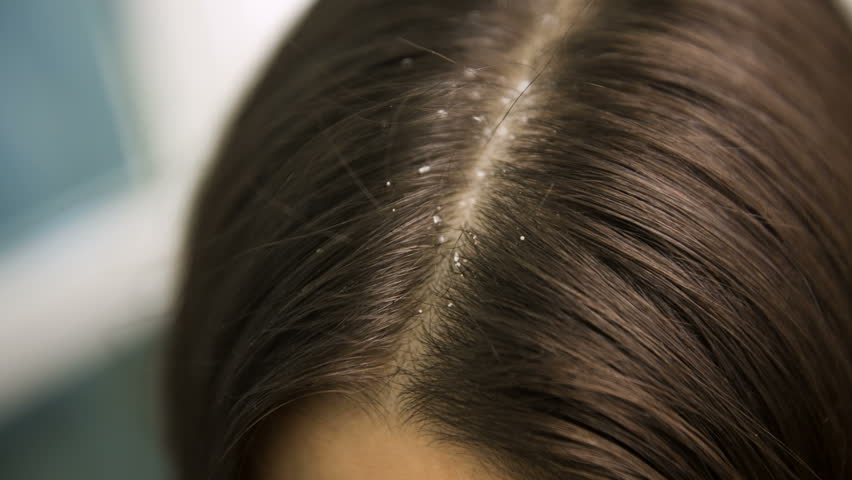 3 Easy Ways To Treat Dandruff Once And For All